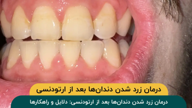 درمان زرد شدن دندانها بعد از ارتودنسی: دلایل و راهکارها